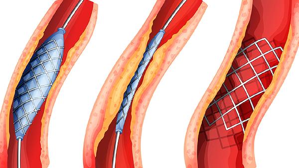 睡前90度倒竖腿的优点